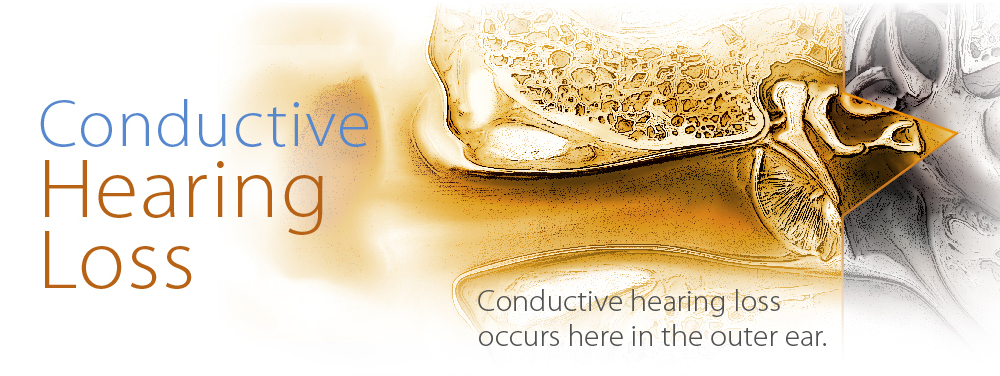 Conductive Hearing loss