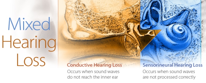 mixed hearing loss