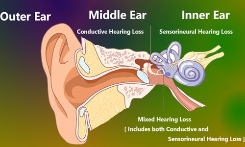 Types of Hearing Loss